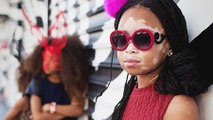 10-Year-Old Model With Vitiligo Wears Her 
