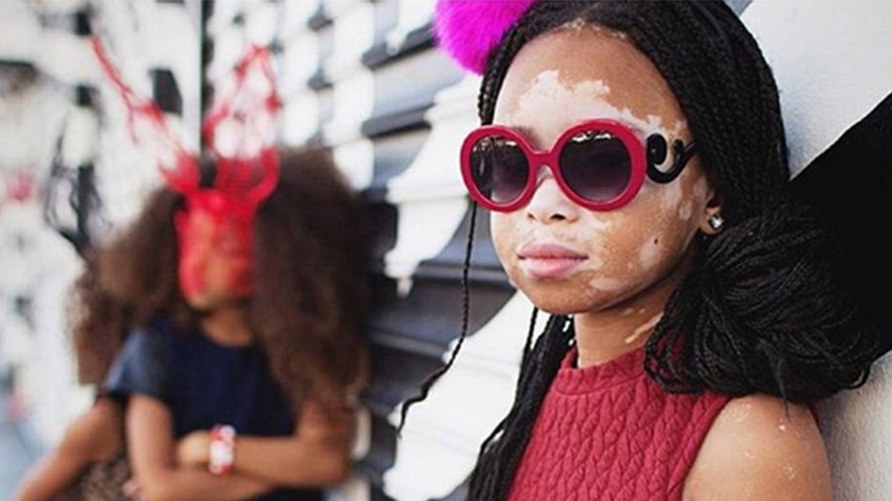 10-Year-Old Model With Vitiligo Wears Her "Love Spots" With Pride