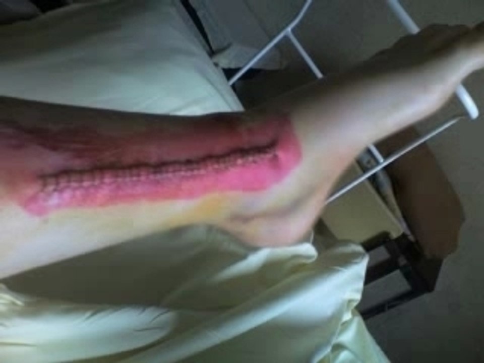 Accident de moto