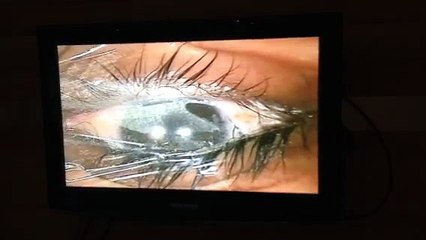 My LASEK Eye Surgery