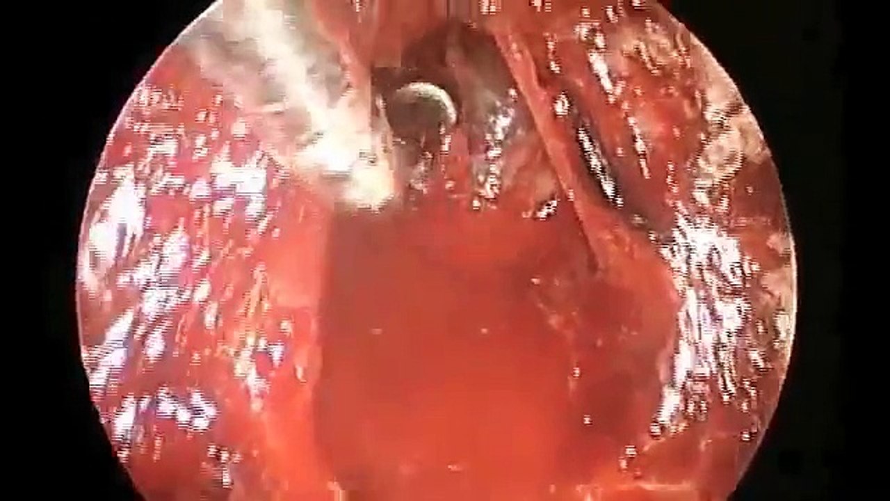 Pituitary gland & Pituitary adenoma