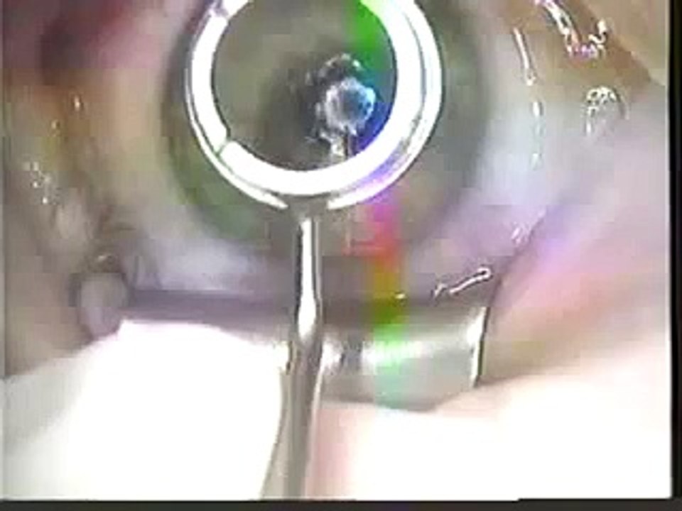 My Road to Vision- Pre- PRK Lasik Surgery Enhancement