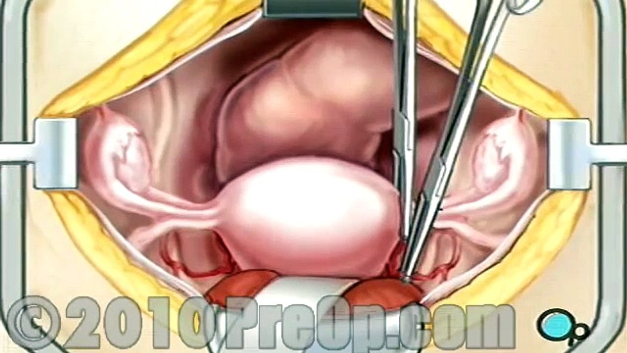 Hysterectomy Removal of the Uterus PreOp® Patient Education