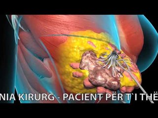 Report TV - Rreze Dielli,  "Jo Kancer" Marredhenia Kirurg - Pacient