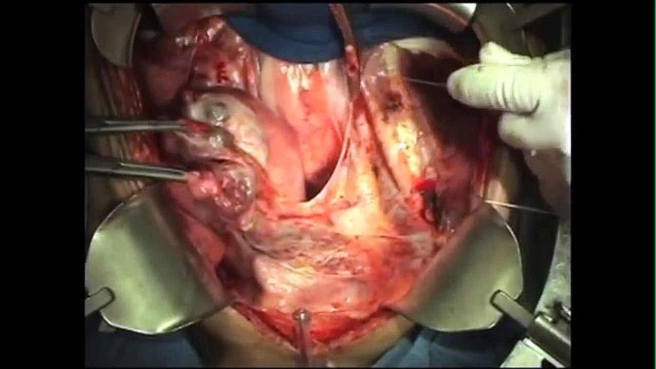 Total Abdominal Hysterectomy: Incision and opening of the pelvic cavity