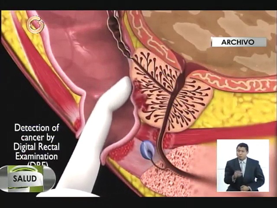 ¿Cómo saber si tiene crecimiento prostático o cáncer de próstata?