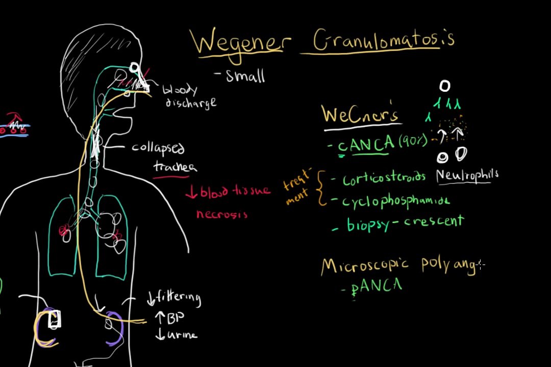Granulomatosis With Polyangiitis (Wegeners) and Microscopic Polyangiitis - Mayo Clinic