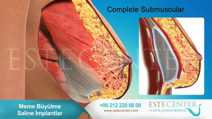 Meme Büyütme Estetiği Operasyonu (Animasyon)