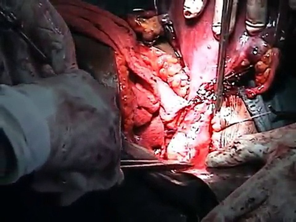 Popular Gynecology & Obstetrics and gynaecology videos