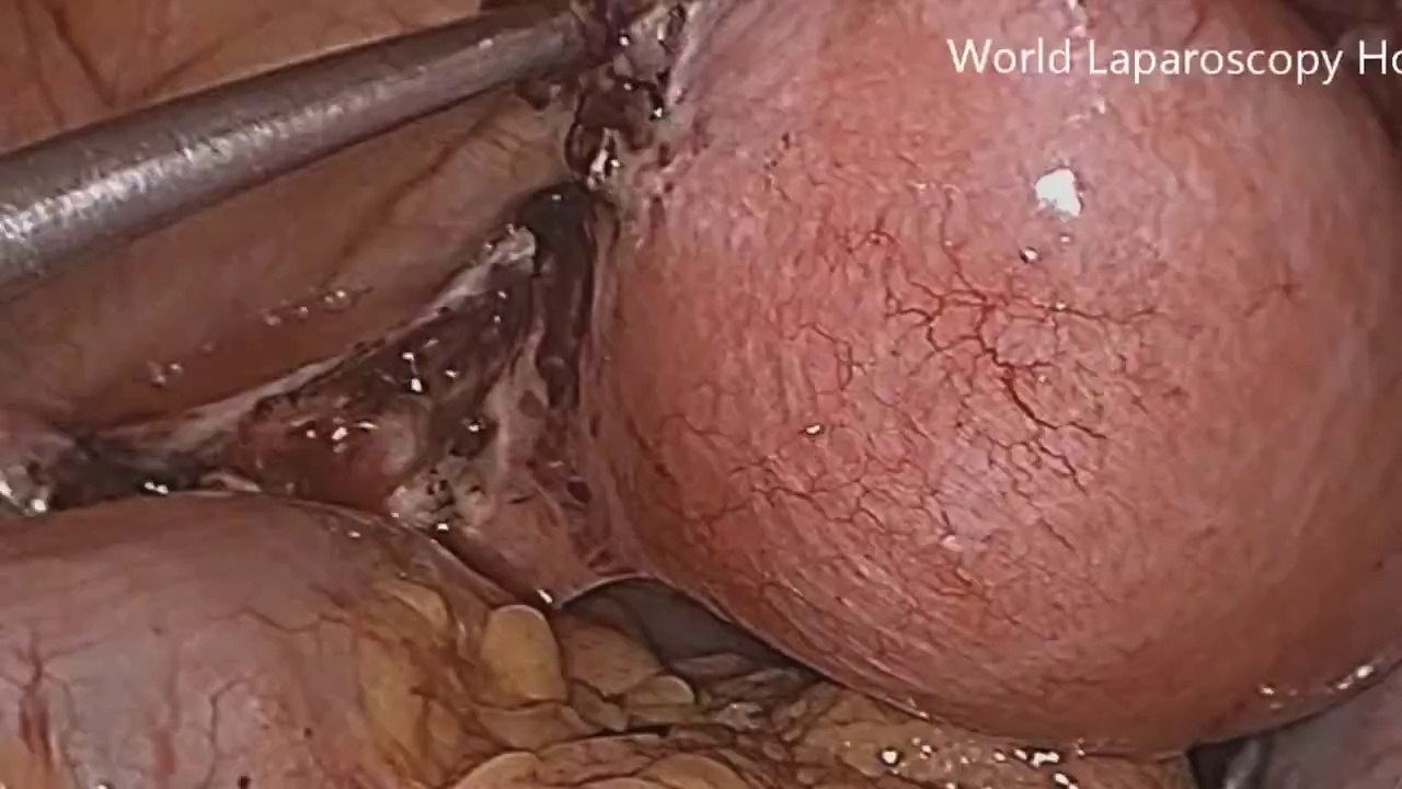 Total Laparoscopic hysetrectomy HD Video