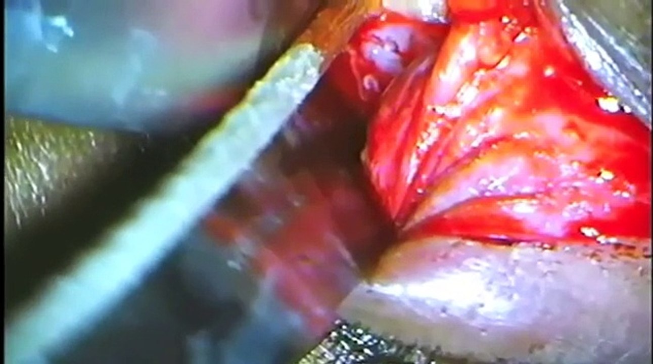 Optic Nerve Sheath Fenestration