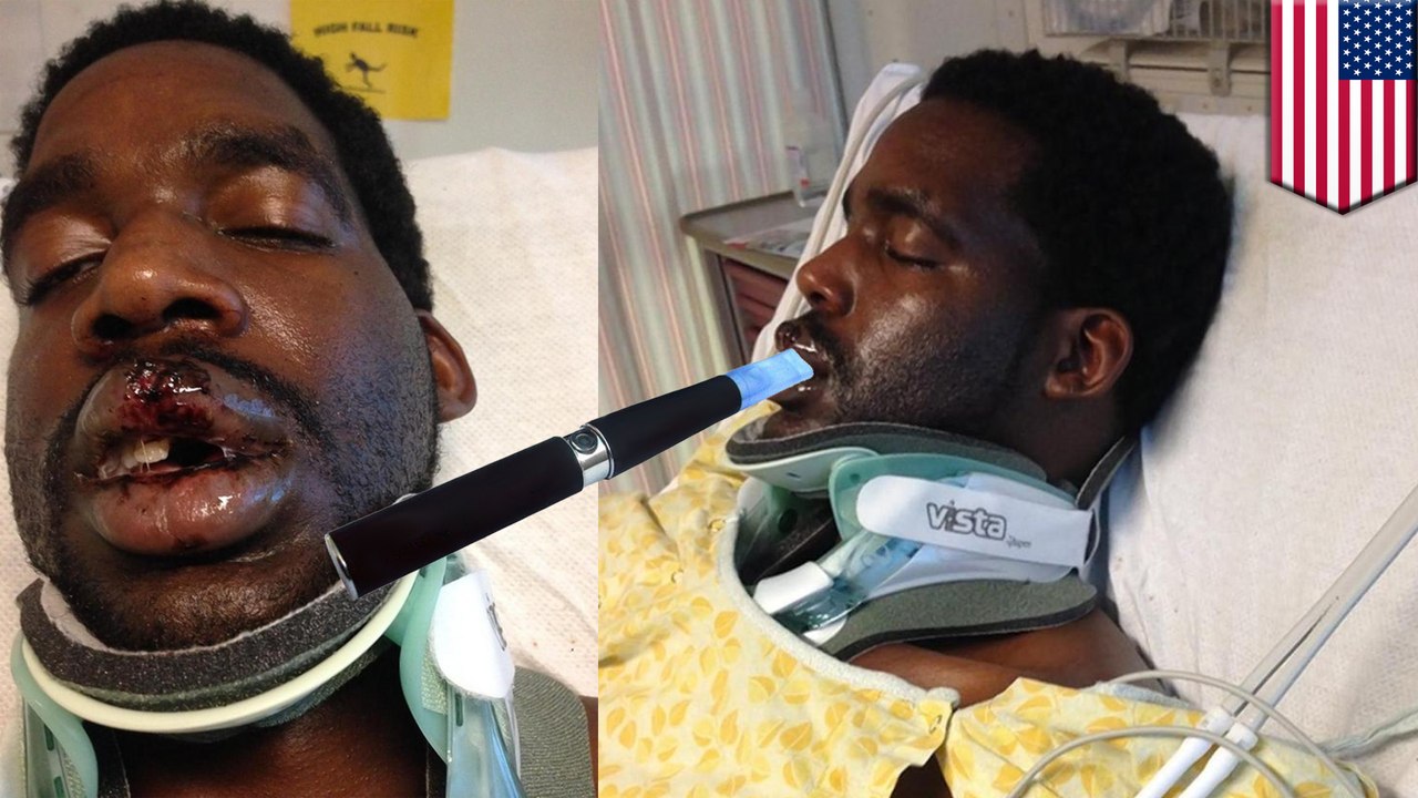 vape explodes in mouth E-cigarette explodes in teen's mouth, breaks jaw and teeth