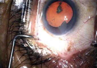 case 1 trabectome phaco superficial keratectomy part 3