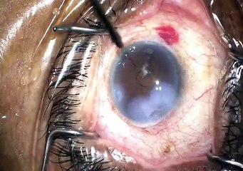 case 1 trabectome phaco superficial keratectomy part 1 narrow angles