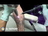 Ecco come eliminare un tatuaggio in pochi minuti senza cicatrici