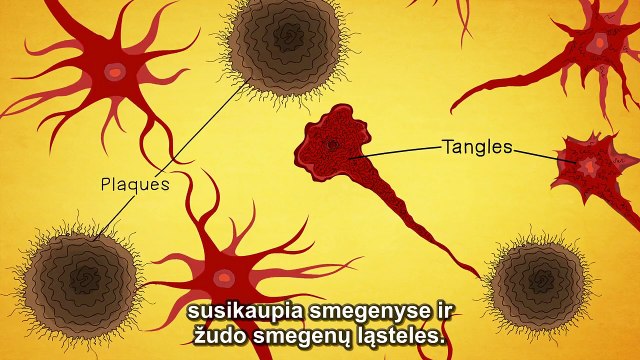 Kas yra Alzheimerio liga? LT subs