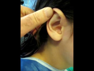 oreilles décollées technique vladimir mitz