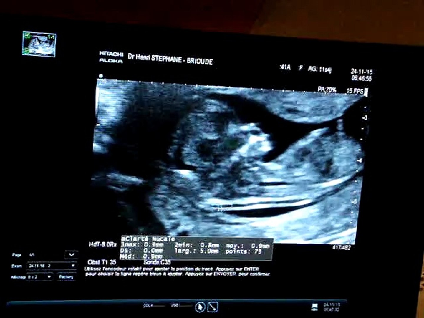 Echographie 3 Mois Video Dailymotion