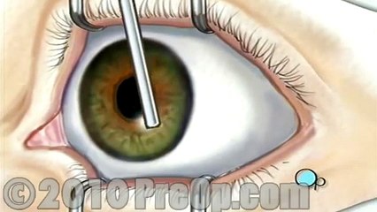 PreOp® Patient Education Opthamology: PRK Laser Eye Surgery