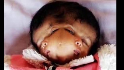 a little baby who has two head by birth