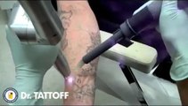 Ecco come eliminare un tatuaggio in pochi minuti senza cicatrici