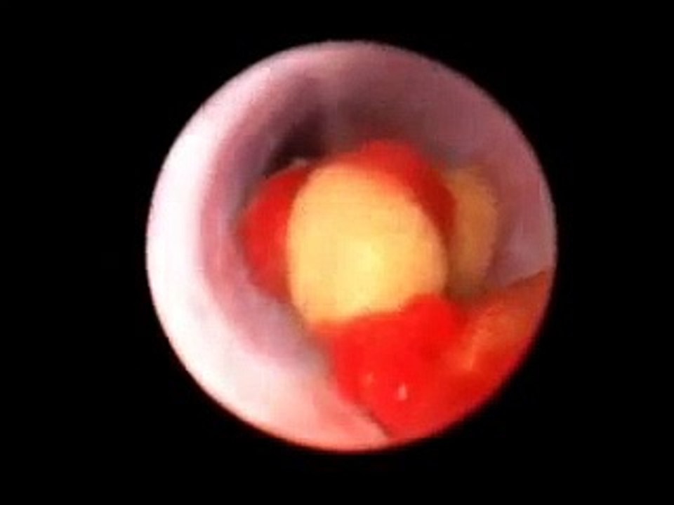Popular Calculus & Laparoscopic surgery videos