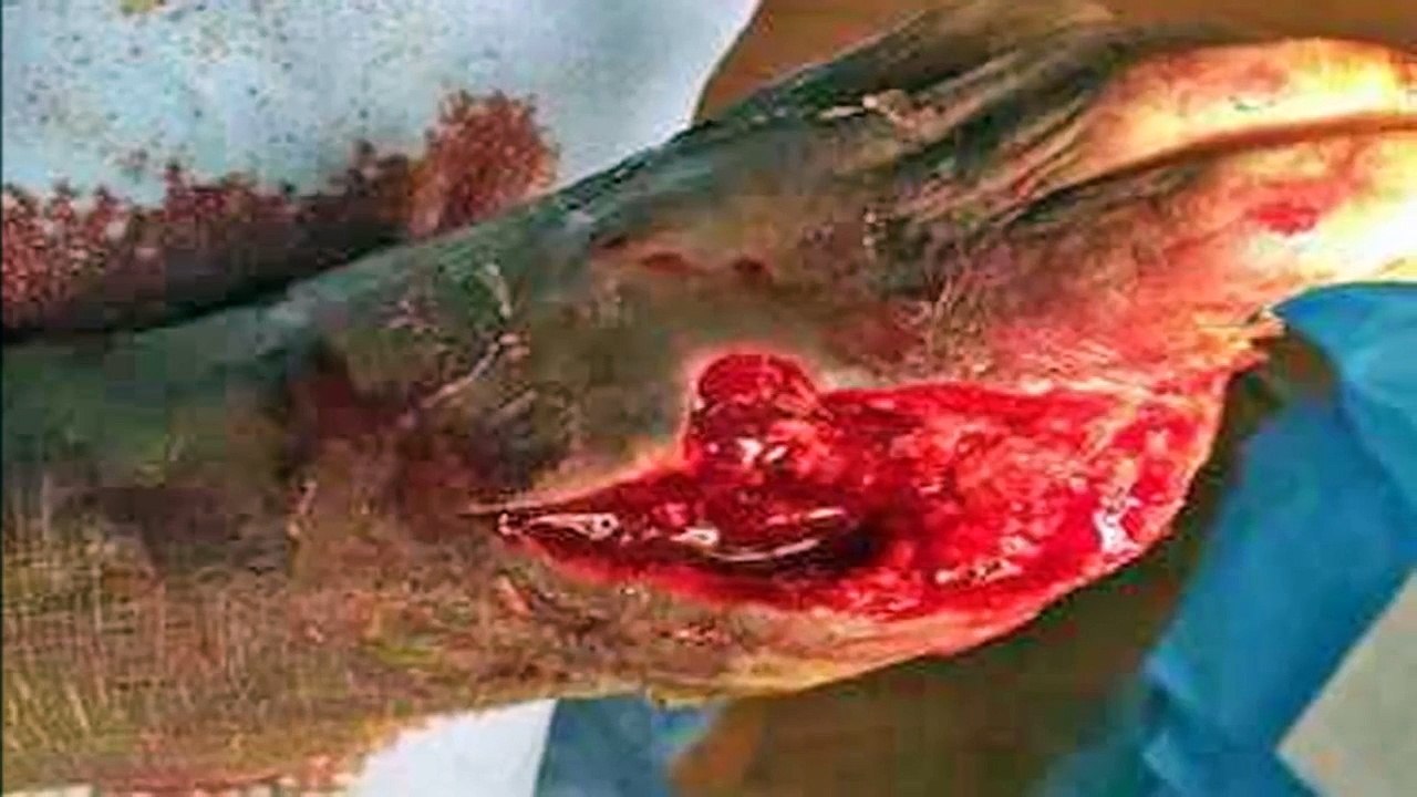Popular Videos - Debridement & Surgery