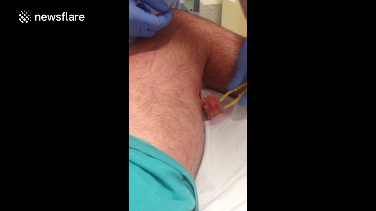 Man films gruesome spider bite injury on his leg in Australia