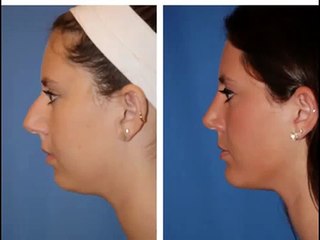 Rhinoplasty Portland Oregon. Best Rhinoplasty Surgeon in Portland OR