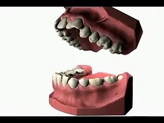 Кариес зубов и его лечение