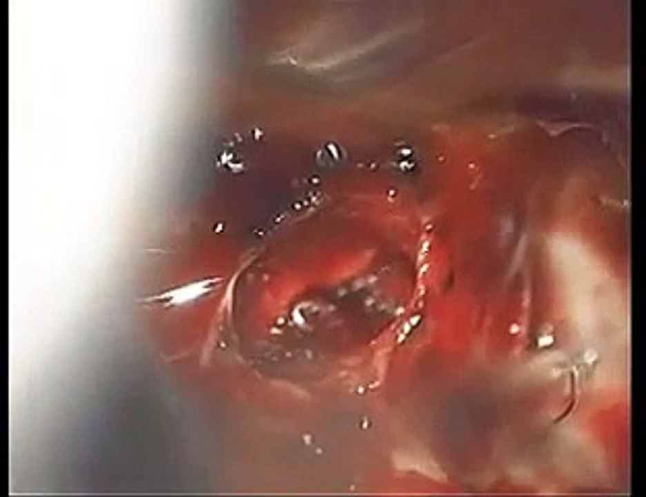 Transnasal transsphenoidal pituitary adenoma surgery