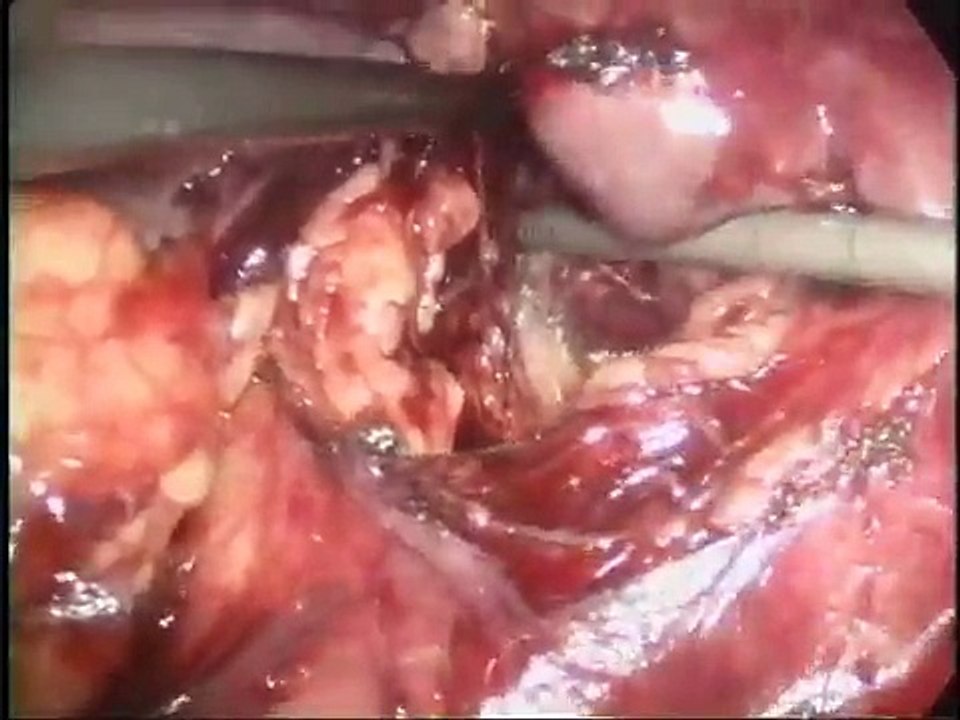 Kidney Transplant Donor Surgery: Laparoscopic Live Donor Nephrectomy