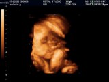 3D and 4D ultrasounds imaging Lehi,UT -4 LIVE