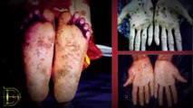 5 Most Mysterious Diseases on Earth