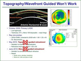 Refractive surgery & Photorefractive keratectomy