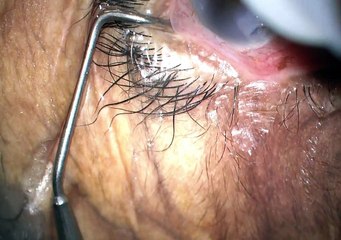 case 1 trabectome phaco superficial keratectomy part 1 narrow angles