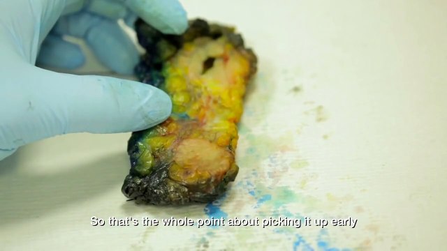 Queen Mary University of London - Cancer