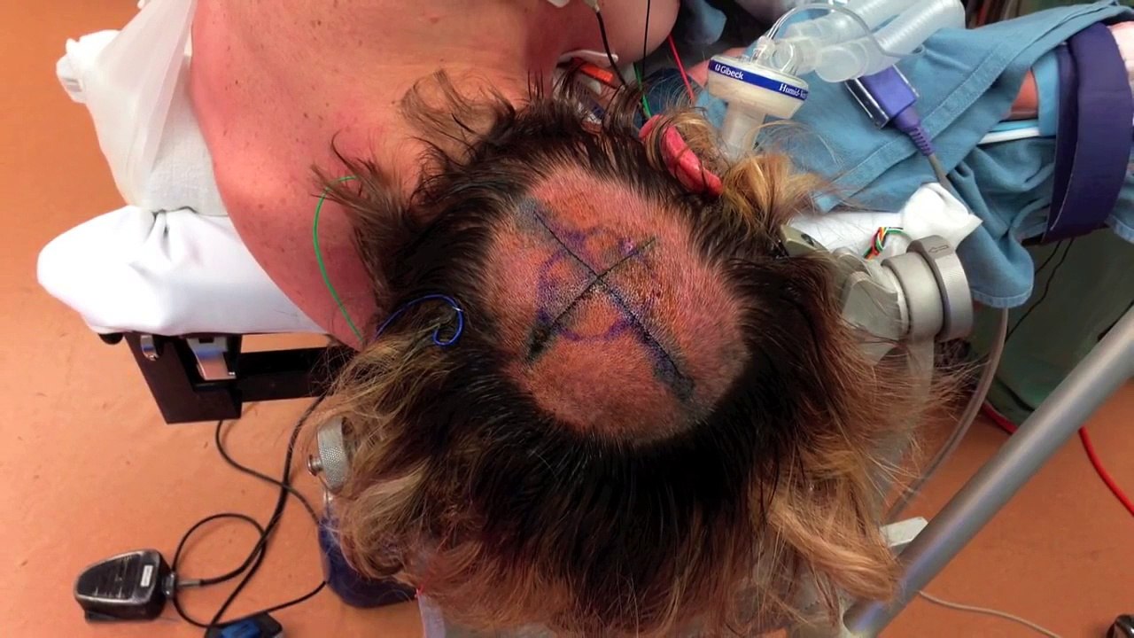 Craniotomy