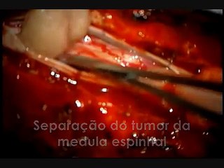 Tumor do tronco encefálico - Hospital Regional Norte - Dr Gerardo Cristino Filho