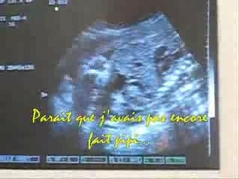 Echo dernière moitié du 6ème mois