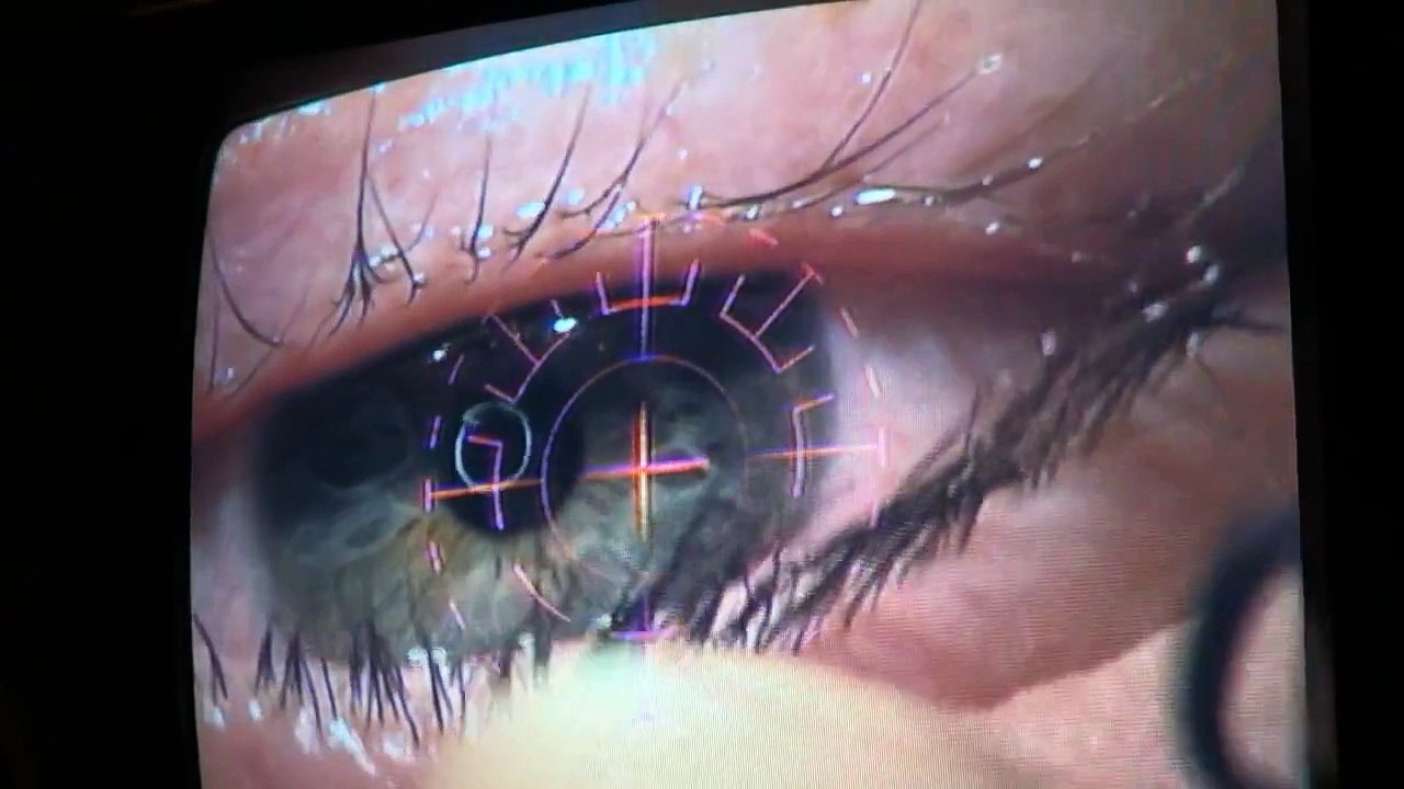 PRK Laser Eye Surgery - My Experience