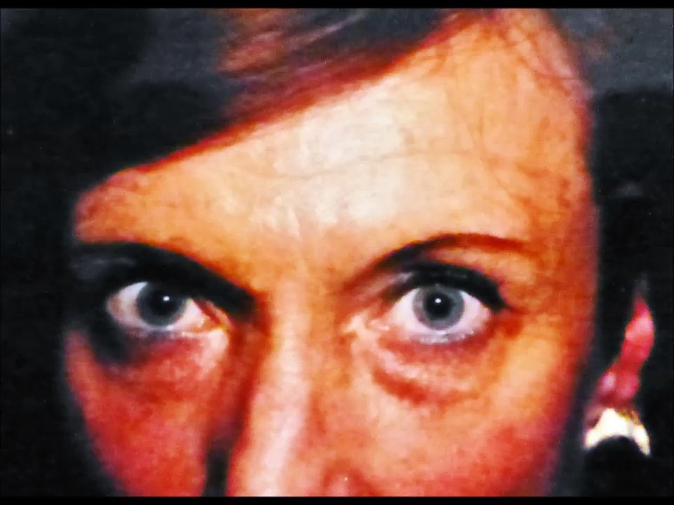 blepharoplastie après 20 ans d'évolution,par vladimir mitz