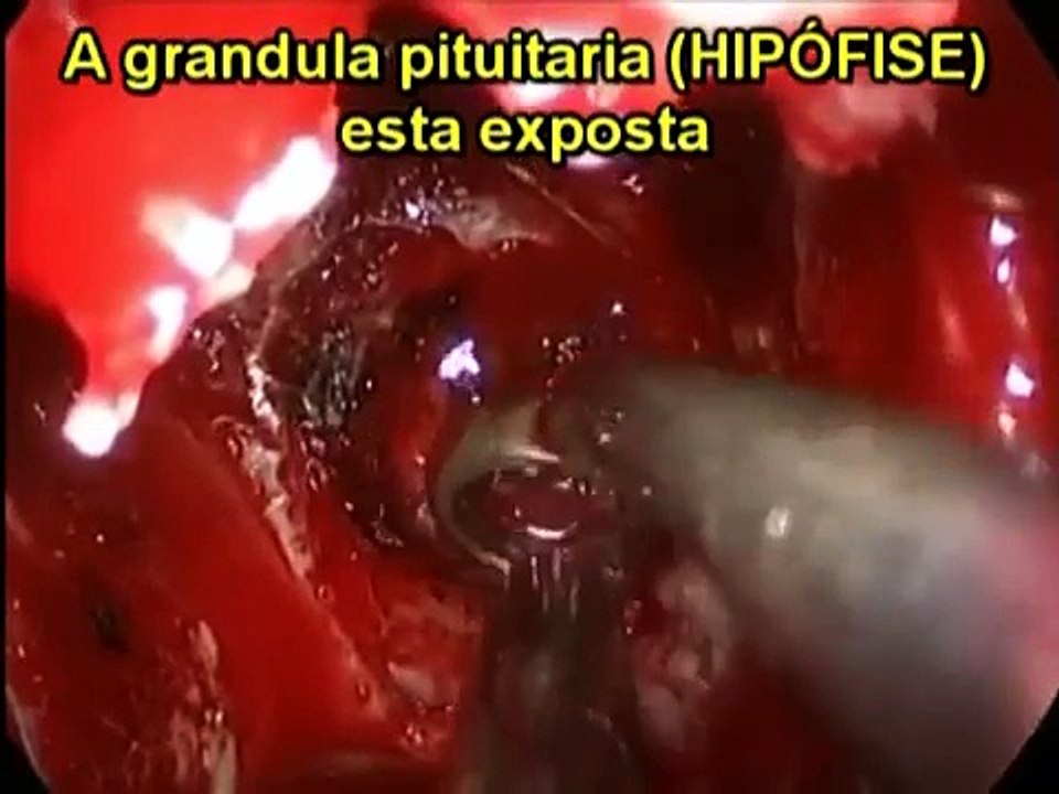 Acromegalia - Cirurgia endoscópica para remoção do tumor de hipófise