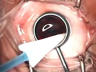 The management of cornea blindness from severe corneal scarring - Video abstract: 27175