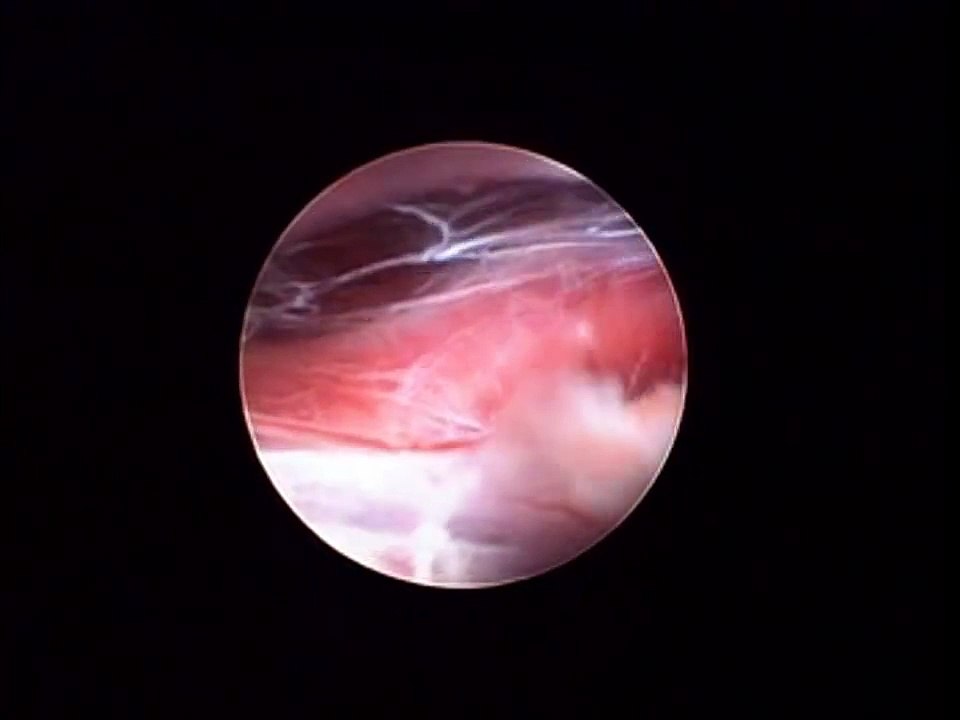 Pineal tumor surgery - subtentorial supracerebellar approach