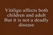 Treatment for Vitiligo Provides Complete Relief Through Homeopathy