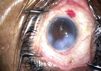 case 1 trabectome phaco superficial keratectomy part 1 narrow angles