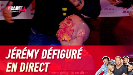 Jérémy défiguré en direct - C'Cauet sur NRJ