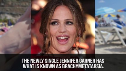10 Celebrities With Physical Deformities