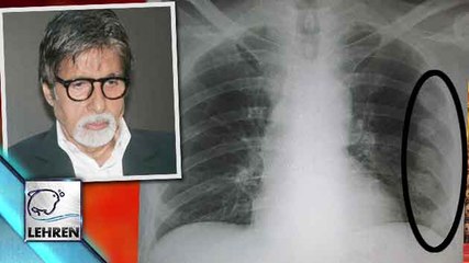 OMG! Amitabh Bachchan's Ribs DAMAGED